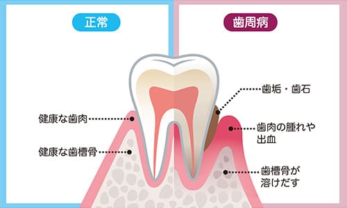 歯周病は歯を失う怖い病気です