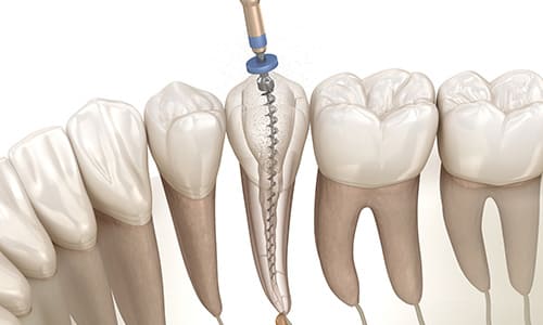 根管治療は重度の虫歯でも歯を残せる治療法